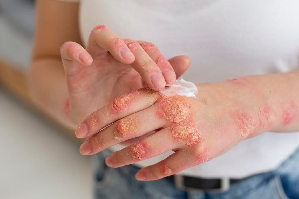 Dermatitis (Eczema)